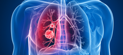Guidance on targeted drug use for lung cancer